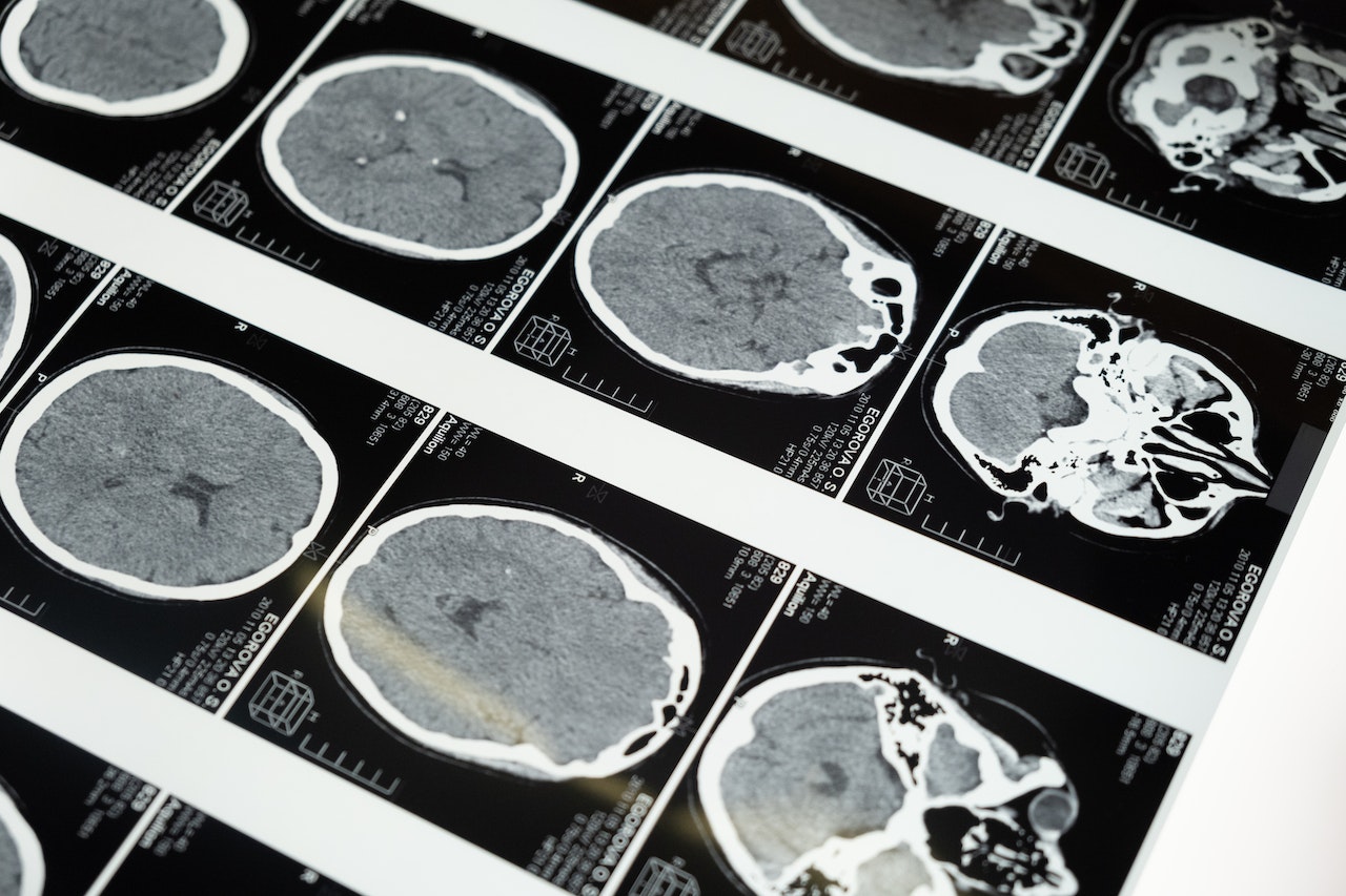 MRI Images of the Brain | Veteran Car Donations

