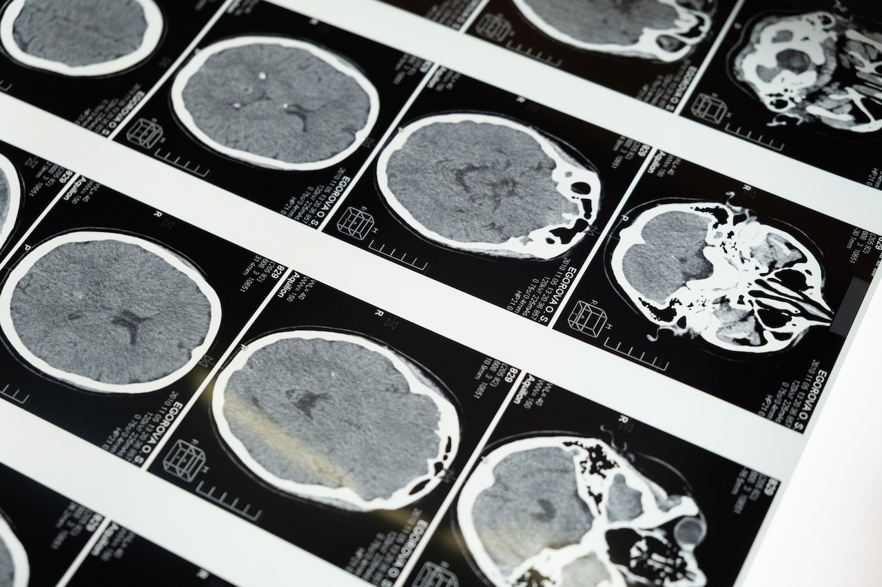 MRI Images of the Brain | Veteran Car Donations